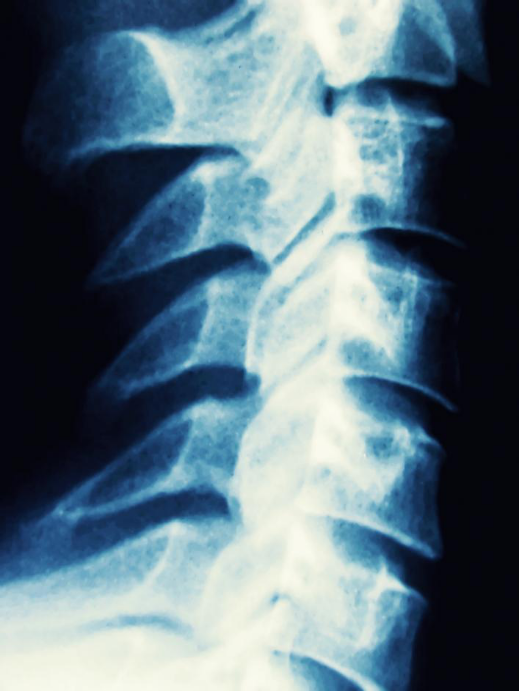 A Misaligned Spine