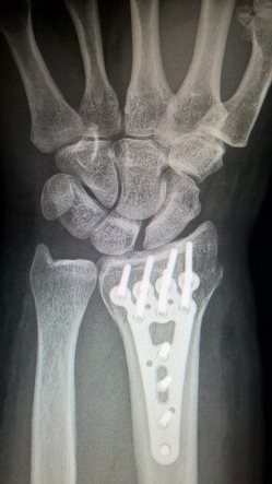 fractured bone