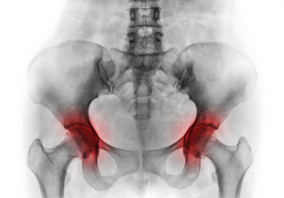 Female Hip Pain